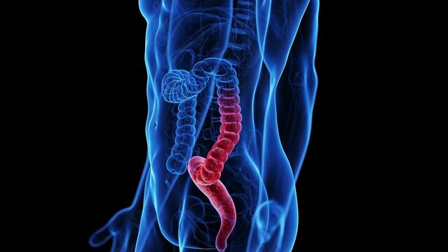 Animation of the colon of a man with colitis ulcerosa