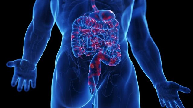 Animation of the colon of a man with Crohn's disease