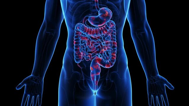 Animation of the colon of a man with Crohn's disease