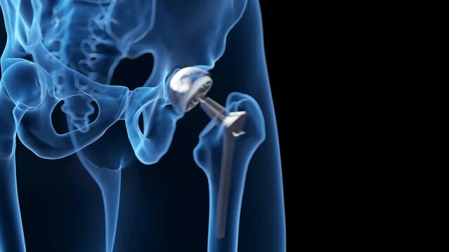 Animation of a hip replacement