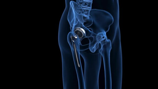 Animation of a hip replacement