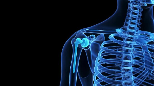 Animation of a shoulder replacement