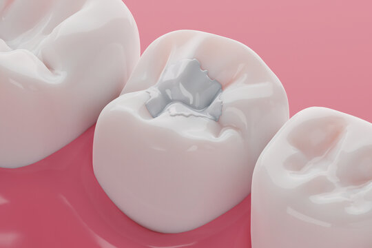 Teeth white composite filling, Decay and broken teeth treatment concept. 3D rendering.