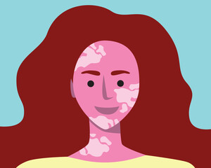 Natural beautiful woman with skin patches, modern fashion persona with vitiligo, flat vector stock illustration