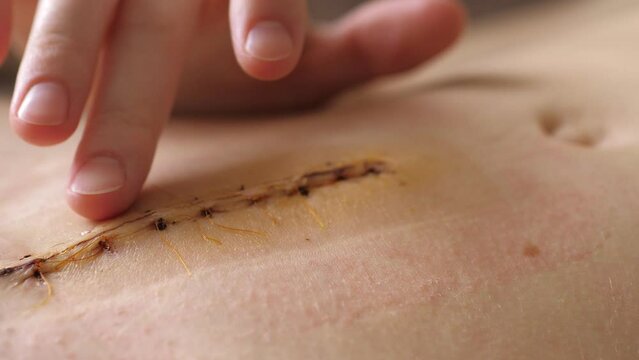 Abdomen of young girl. Closeup video of the long scar above navel after abdominal surgery for umbilical and inguinal hernias. Irritation from the patch. Postpartum recovery.