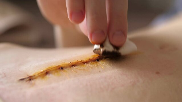 Abdomen of young girl. Closeup video of the long scar above navel after abdominal surgery for umbilical and inguinal hernias. Woman is treating the scar with betadine. Postpartum recovery.