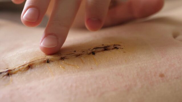 Abdomen of young girl. Closeup video of the long scar above navel after abdominal surgery for umbilical and inguinal hernias. Irritation from the patch. Postpartum recovery.