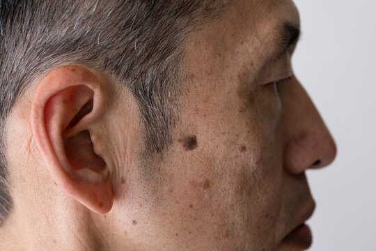 中年男性の顔のシミのクローズアップ
