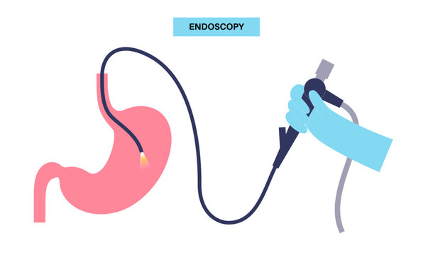 Gastroscopy endoscopy procedure