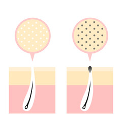 Comparison illustration of normal pores and darkened pores clogged with sebum.
skin care concept.