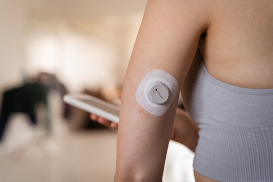 MINSK, BELARUS - June, 2023: Woman is preparing monitoring of blood sugar level Dexcom G7. Life with diabetes