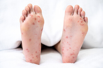 Enterovirus foot red spots blisters on the skin of on the body of a child virus on bed at hospital