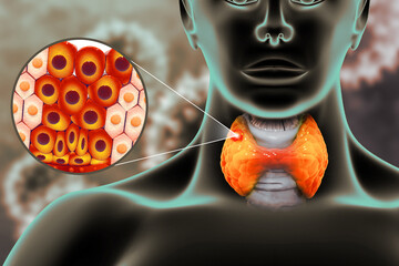 Thyroid gland cancer. showing thyroid gland with tumor. 3d illustration - obrazy, fototapety, plakaty