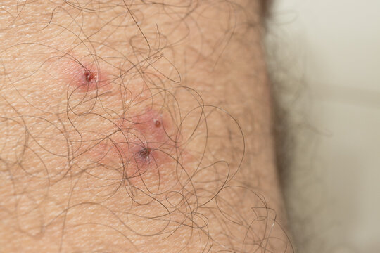 Mosquitos Bites that appear to be slightly infected from scratching 