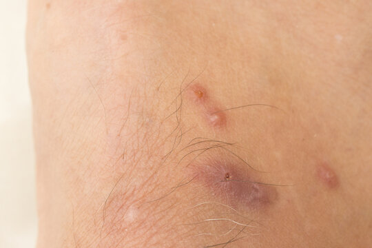 Mosquitos Bites that appear to be slightly infected from scratching 