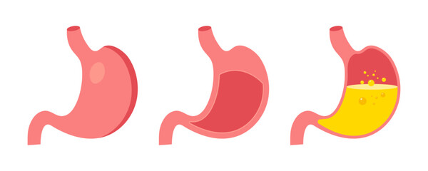 Human stomach. Internal organ, digestive system anatomy, stomach care. Healthy and unhealthy, empty and full human stomach in different style. Nutrition, stomach pain, bloating