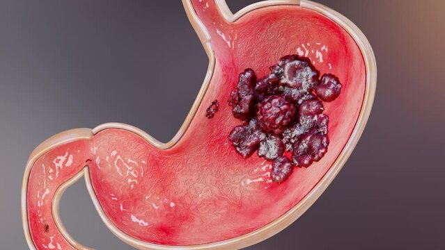 Stomach cancer. stages tumor growth in digestive system, Peptic Ulcer, Cancer attacking cell. gastric disease concept. symptoms, malignant cancerous, viruses and bacteria, Cross section, 3d render