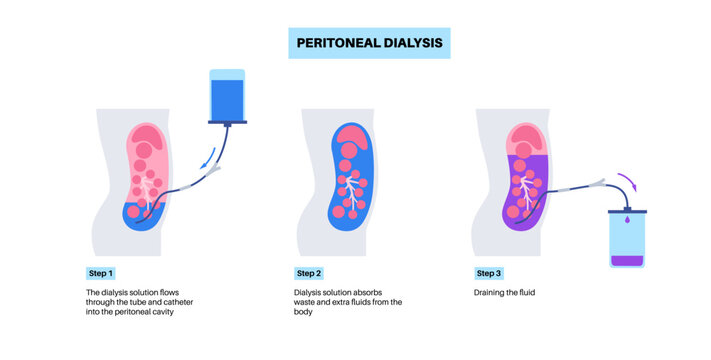 Peritoneal dialysis concept