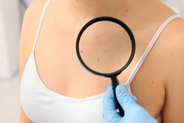 Dermatologist examining patient's birthmark with magnifying glass indoors, closeup