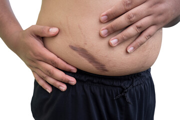keloid scar on fat belly after appendectomy