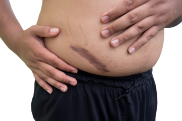 keloid scar on fat belly after appendectomy