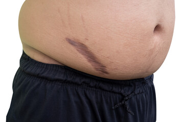 keloid scar on fat belly after appendectomy