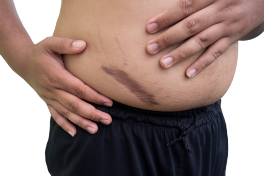 keloid scar on fat belly after appendectomy