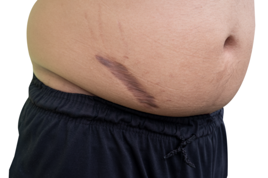 keloid scar on fat belly after appendectomy