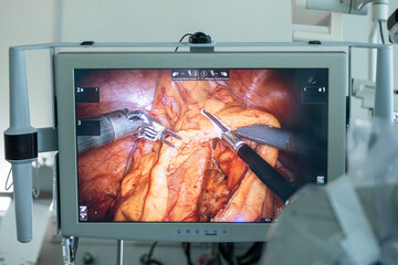 A laparoscopic surgeon at work, performing a minimally invasive surgery, using a robot-assisted, advanced medicine