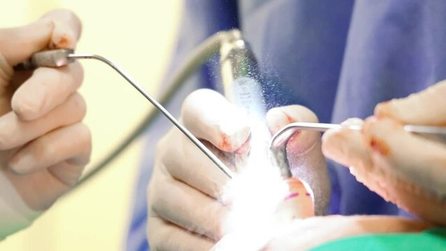 4K close-up footage of pre-ultrasonic piezo rhinoplasty cosmetic surgery. Doctor doing surgery with water spraying piezo. Vibration, sound wave, piezoelectric application. Nose job, medical device.
