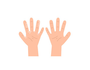 Illustration of palms with skin diseases and palms in good and healthy condition. itching on the palms. eczema and allergic reactions. peeling skin. health problems. illustration design. vector 