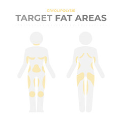 Target fat areas for Cryolipolysis. 
Vector infographic medical of pictograms of the human body with fat deposit and treatment areas for fat freezing
Poster of Anatomical location of localized fat mas