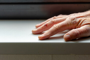 Healthcare and medical concept, Selective focus of a man's hand on window still, Dry skin hand with...