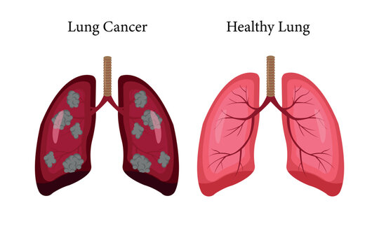 lung cancer and normal lung illustration comparation. bacteria invection. eps 10. icon set