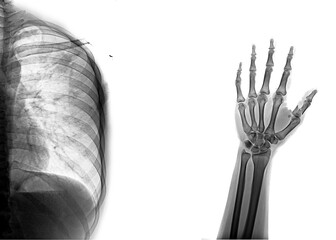 x ray image of human hand