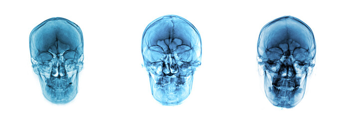 Collection X-ray of skull bone