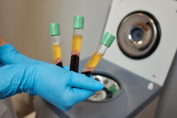 Beautician doctor's hands put test tube with blood in centrifuge container. Rejuvenation...
