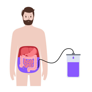 Abdominal paracentesis poster