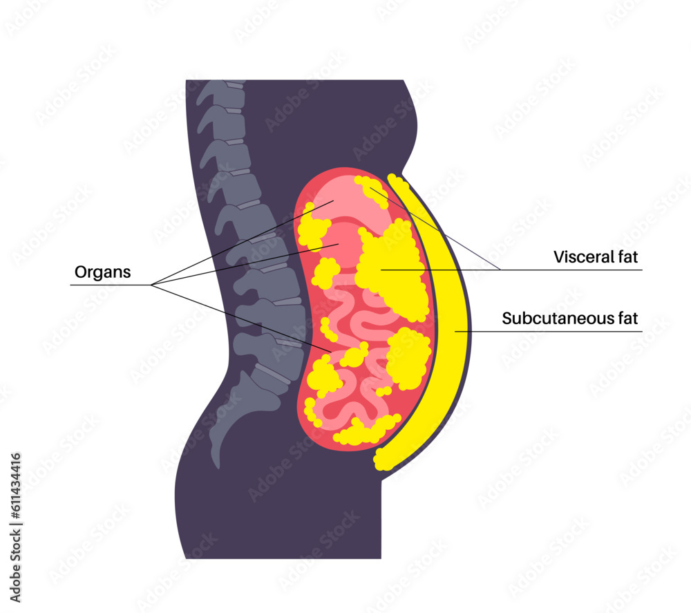 Wall mural Visceral fat diagram