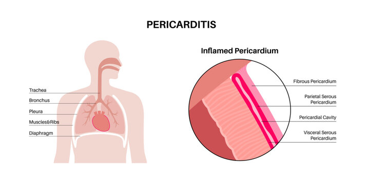 Pericarditis heart disease