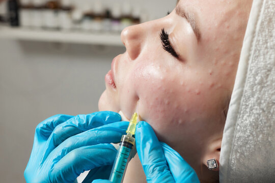 Syringe with a patient's blood plasma in a cosmetologist's hand for a plasmolifting of a woman's facial skin. Plasma therapy, skin cell restoration.