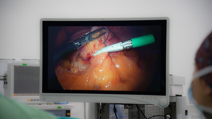 monitor during laparoscopy surgery. Obesity surgery and monitor in the operating room