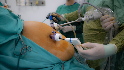 Obesity surgery. Weight loss surgery with laparoscopy technique.