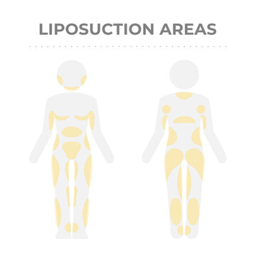 Target areas for liposuction treatment.
Vector infographic medical pictogram of the human body with fat deposit marks.
Graphic scheme of localized fat mass tissue in front and back body parts