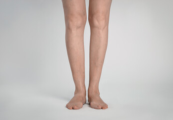 Closeup view of woman with varicose veins on light background