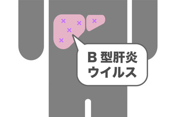 B型肝炎ウイルスに感染した肝臓のイラスト