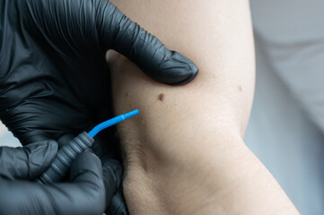 Dermatologist removes a mole on a patient's arm using an electrocoagulator. 