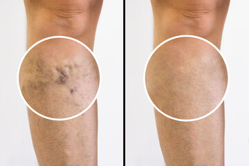 Person Leg With Varicose Veins And Capillaries Before