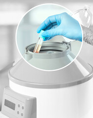 The blood tube is removed from the medical centrifuge for plasma lifting. Prp procedure.