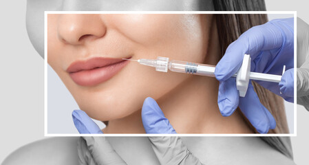 Cosmetologist does injections for lips augmentation and anti wrinkle in the nasolabial folds of a...